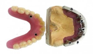 prótesis dentales híbridas