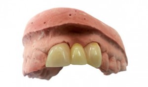 prótesis dentales provisionales